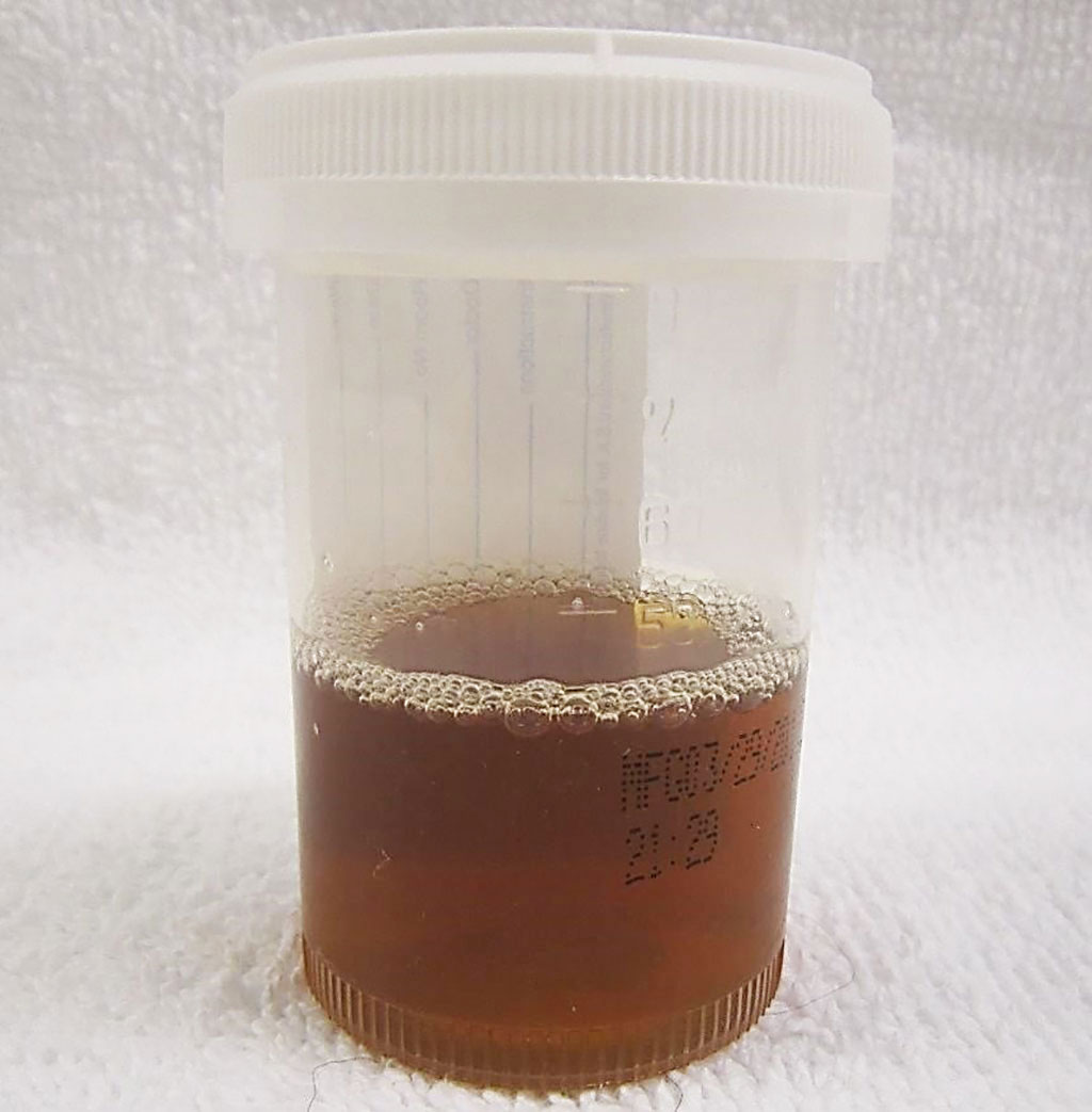 Image: Urine from a person with rhabdomyolysis showing the characteristic brown discoloration as a result of myoglobinuria (Photo courtesy of James Heilman, MD).