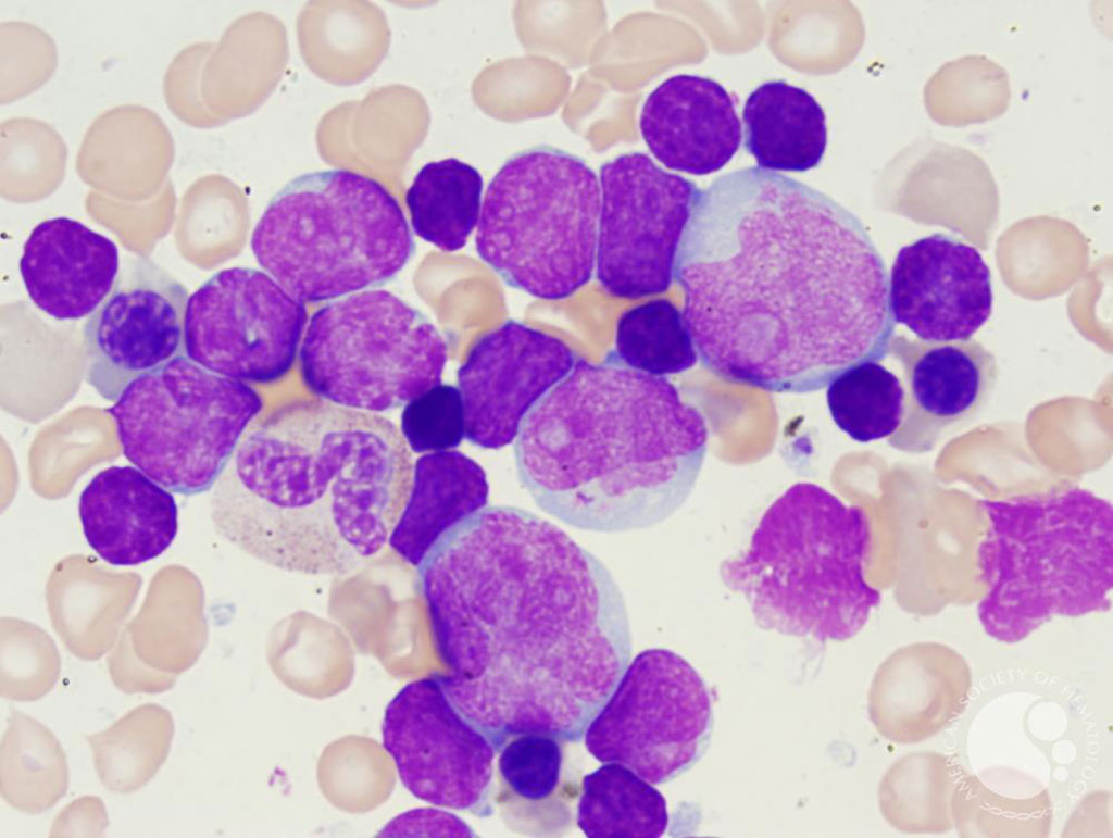 Image: Bone marrow smear from a patient with mixed phenotype acute leukemia. The marrow aspirate smear has 71% blasts by differential count, with a similar dimorphic morphology as in the peripheral blood with numerous blasts with a dimorphic morphology (Photo courtesy of Elizabeth Courville, MD).