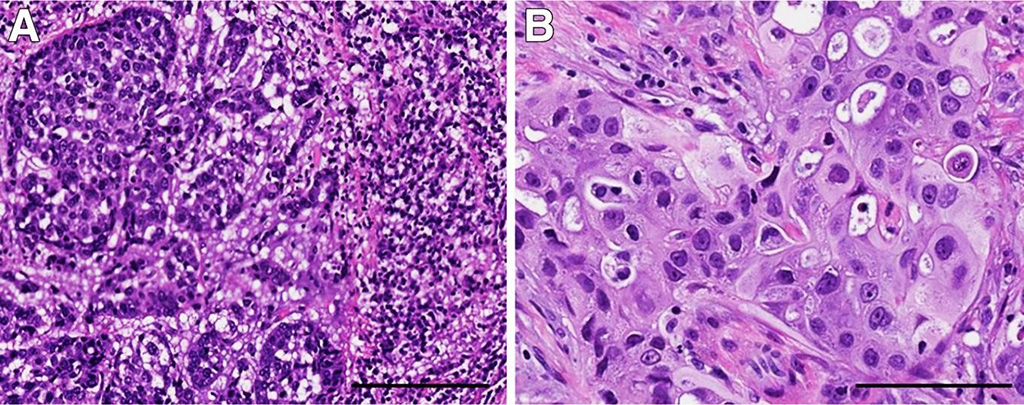 Image: Morphologic variants of triple-negative breast cancer (TNBC) with different genetic alterations. A: TNBC with basal-like histologic features containing a prominent stromal lymphocytic infiltrate; this tumor had MYC amplification. B: TNBC with apocrine differentiation and a PI3KCA mutation. The tumor cells have abundant eosinophilic cytoplasm, round nuclei, and prominent nucleoli (Photo courtesy of Geisel School of Medicine).