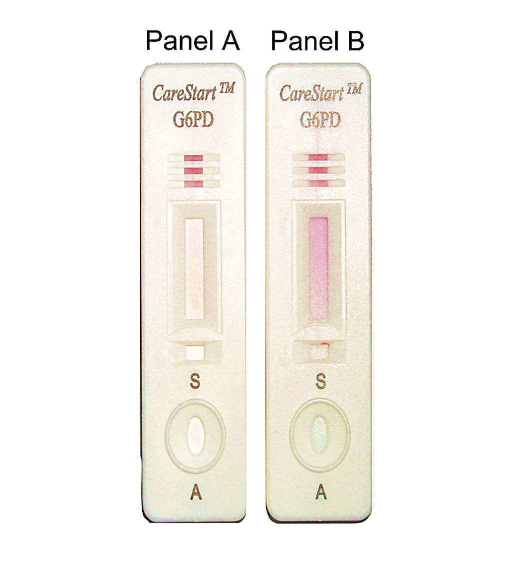 Image: Design of the CareStart G6PD deficiency screening test and interpretation of the results:  Panel A, no color change for sample with deficient G6PD enzymatic activity; Panel B, distinct purple color for sample with normal G6PD enzymatic activity (Photo courtesy of Charles Darwin University).