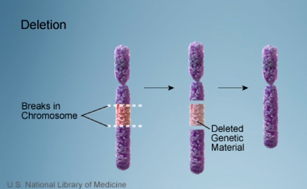 Image: 22q11.2 deletion syndrome is a disorder caused by the deletion of a small piece of chromosome 22. The deletion occurs near the middle of the chromosome at a location designated q11.2 (Photo courtesy of U.S. National Library of Medicine)