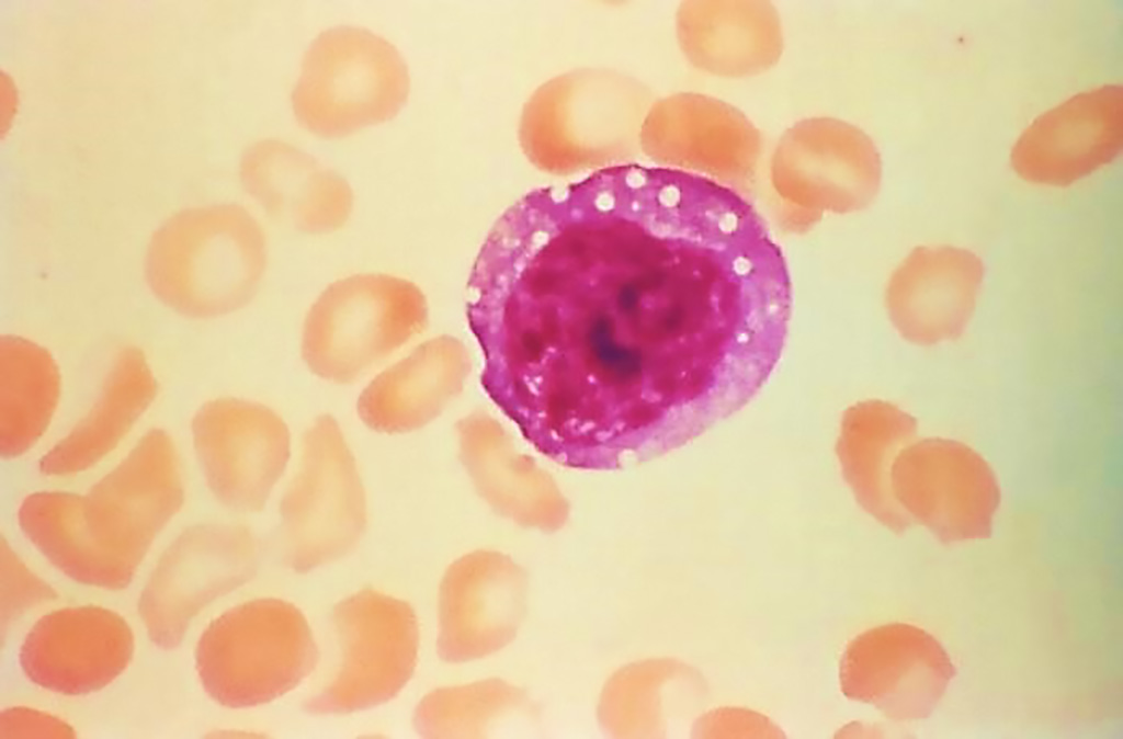 Image: This micrograph depicts an atypical, enlarged lymphocyte found in the blood smear from a hantavirus pulmonary syndrome (HPS) patient. This large atypical lymphocyte is an example of one of the laboratory findings, which when combined with a bandemia, i.e., immature white blood cells, and dropping platelet count, is characteristic of HPS (Photo courtesy of Centers for Disease Control and Prevention)