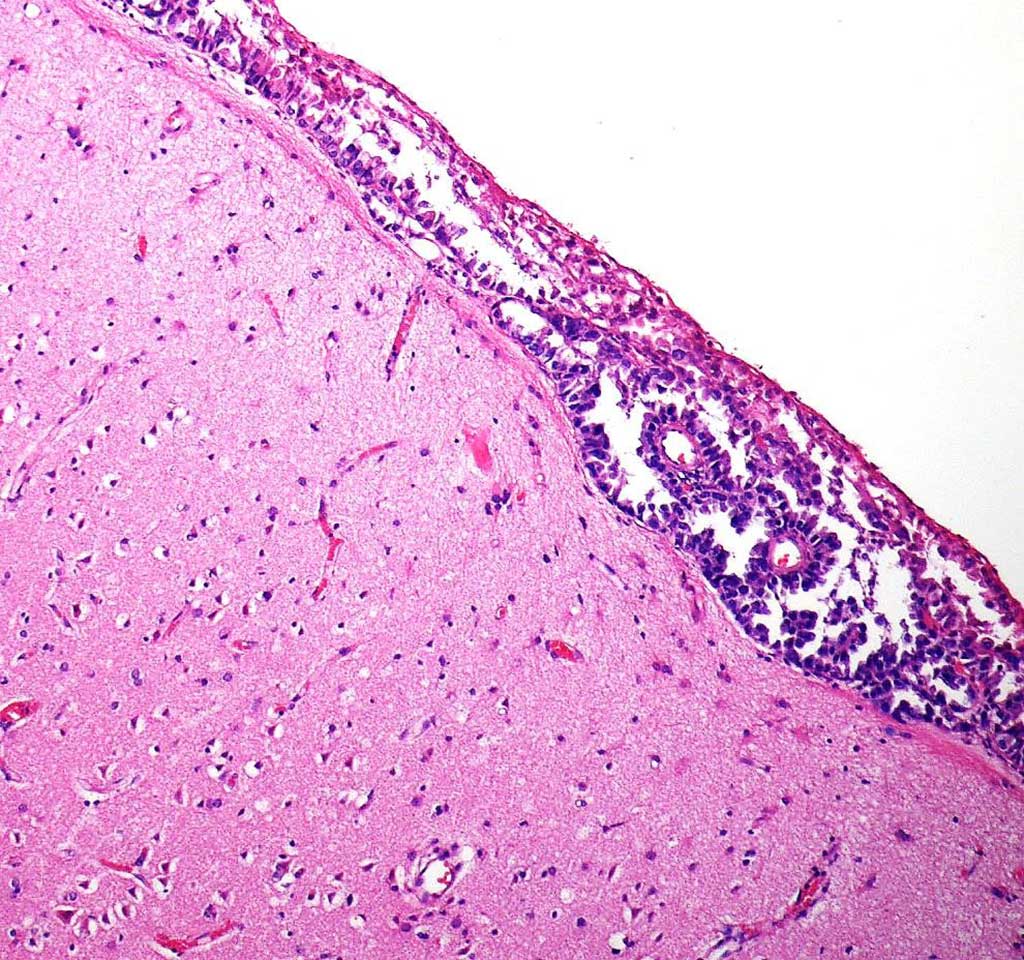 Image: Histopathology of Leptomeningeal Melanoma Metastases: tumor cell clusters in the subarachnoid space in a brain biopsy (Photo courtesy of selbst).