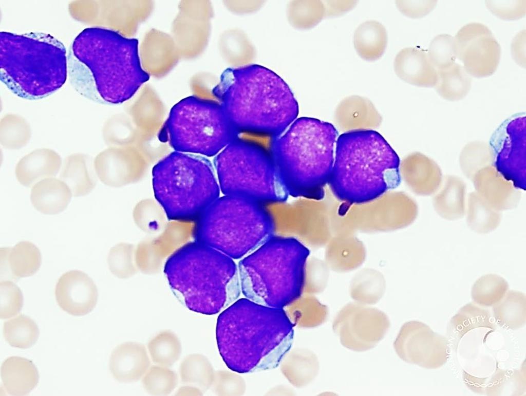 Image: Acute Myeloid Leukemia: The blasts are medium to large in size and have an elevated nuclear: cytoplasmic ratio. The nuclear chromatin is fine and there are prominent nucleoli. Frequent blasts show indented or “cup-shaped” nuclear contours (Photo courtesy of Elizabeth Courville, MD).