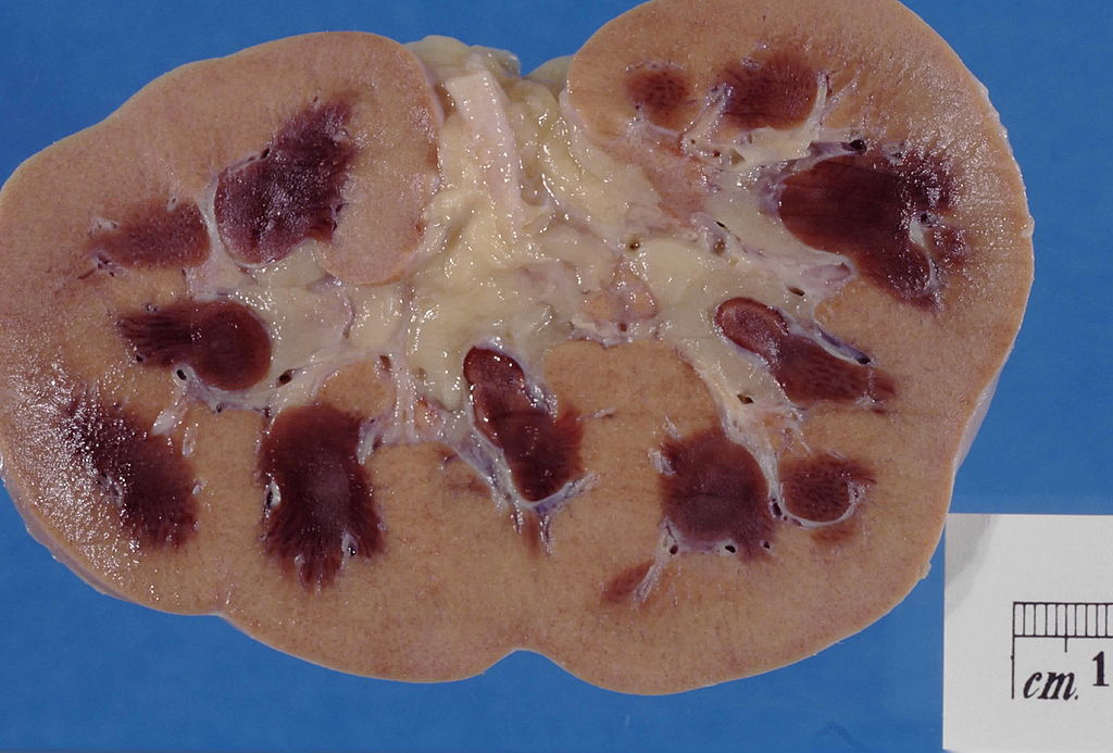 Image: Kidney specimen from patient who died with acute kidney injury. Image shows marked pallor of the cortex, contrasting to the darker areas of surviving medullary tissue (Photo courtesy of Wikimedia Commons)