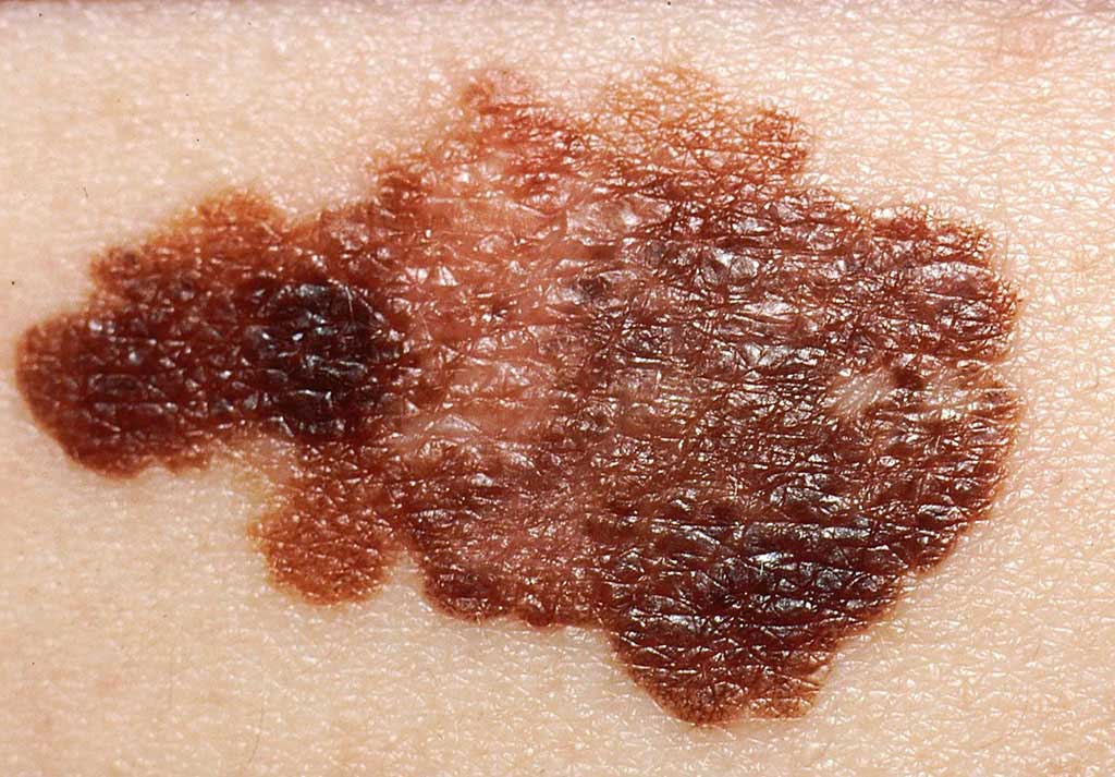 Image: A melanoma on a patient`s skin: a new test predicts which melanoma patients are at risk of cancer recurrence and metastases (Photo courtesy of US National Cancer Institute).