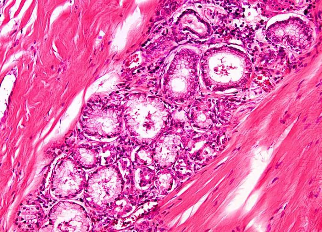 Image: Histopathology of Lung adenocarcinoma (Photo courtesy of Nikon).