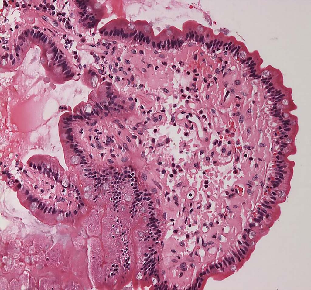 Image: Micrograph showing amyloid deposits. Amyloid shows up as homogeneous pink material in lamina propria and around blood vessels (Photo courtesy of Wikimedia Commons)