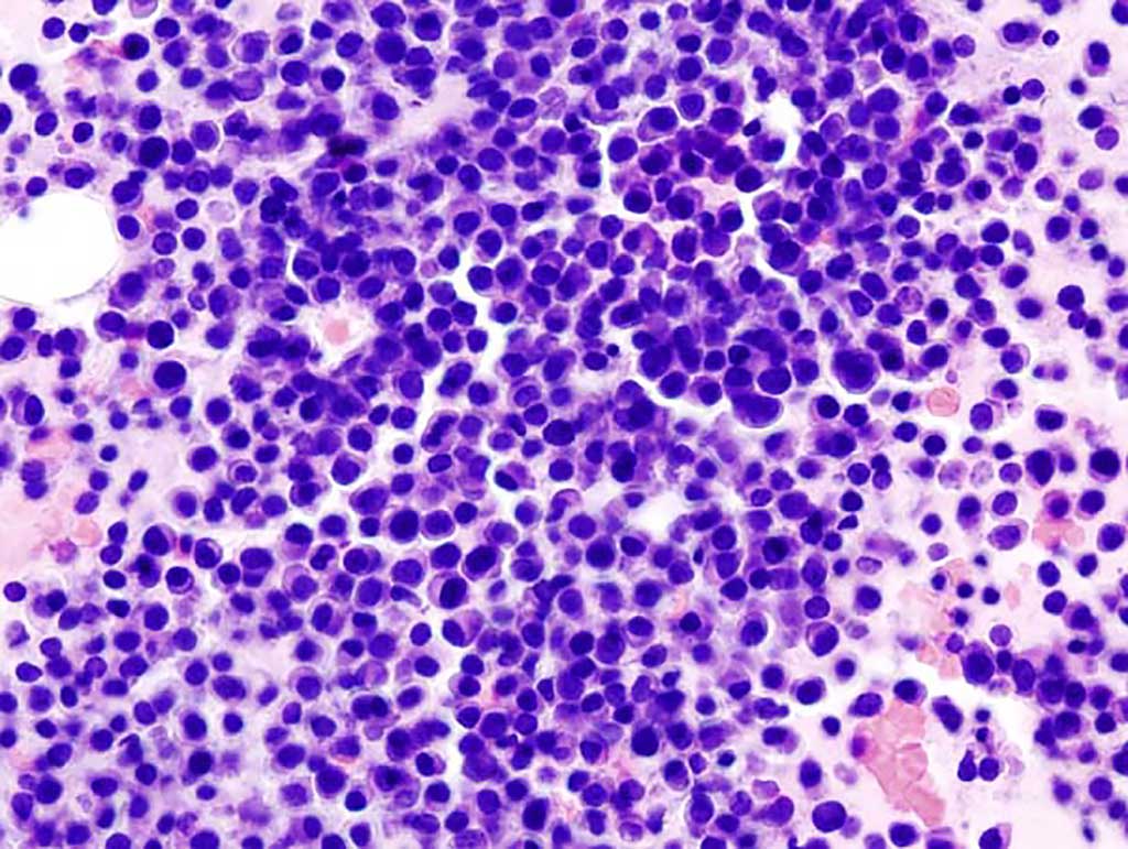 Image: Histopathological image of multiple myeloma from a bone marrow aspirate  (Photo courtesy of Wikimedia Commons)