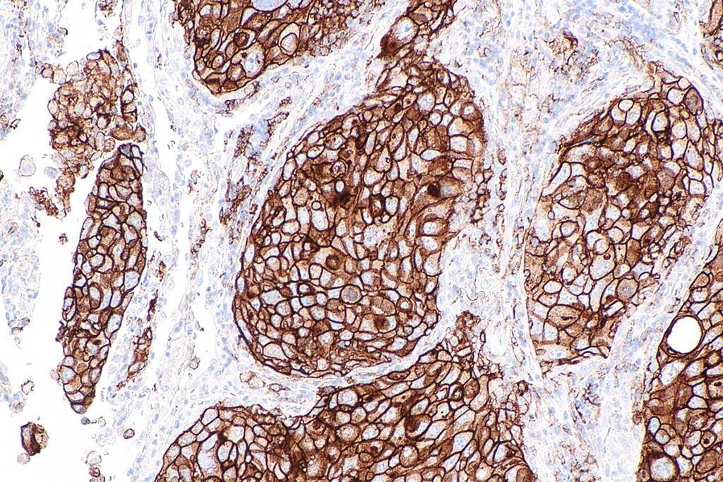 Image: Micrograph showing a PD-L1 positive non-small cell lung carcinoma (Photo courtesy of Wikimedia Commons)