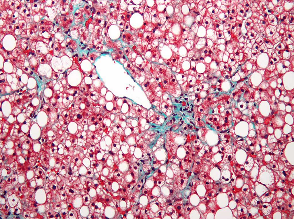 Image: Micrograph of non-alcoholic fatty liver disease, demonstrating marked steatosis (fat in liver cells appears white; connective tissue, blue) (Photo courtesy of Wikimedia Commons)