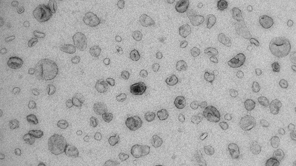 Image: Electron microscope image of urinary extracellular vesicles (EVs) (Photo courtesy of Pekka Rappu, University of Turku).