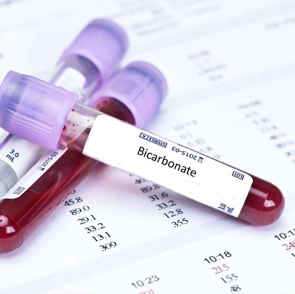 Image: Low levels of bicarbonate in the blood were linked to a higher risk of progression to chronic kidney disease (Photo courtesy of Blood Tests London).