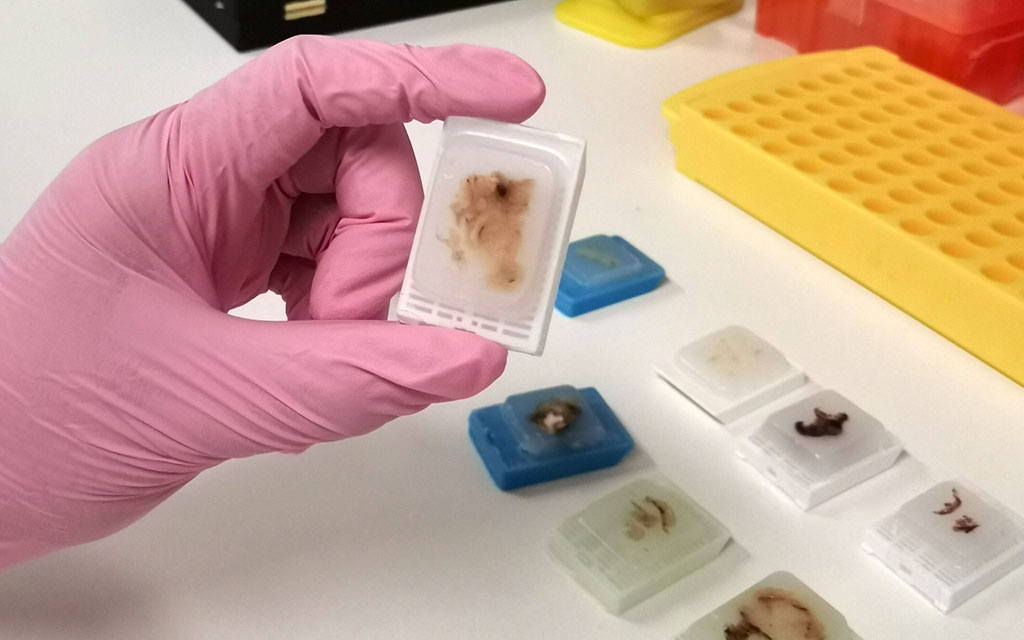 Image: Formalin-Fixed Paraffin-Embedded (FFPE) blocks containing ovarian cancer samples (Photo courtesy of  University of New South Wales)