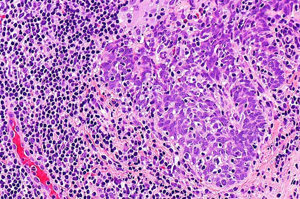 Image: Photomicrograph of histology of a poorly differentiated squamous cell carcinoma (SCC) that is p16 positive (Photo courtesy of Nephron).