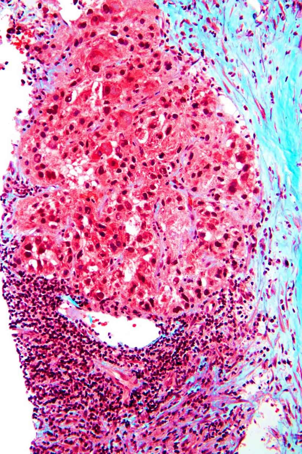 Image: Photomicrograph of histopathology of hepatocellular carcinoma, the most common form of primary liver cancer, showing end-stage cirrhosis - blue collagen (fibrosis) Mallory bodies; loss of normal liver architecture; and nuclear atypia. (Photo courtesy of Nephron).
