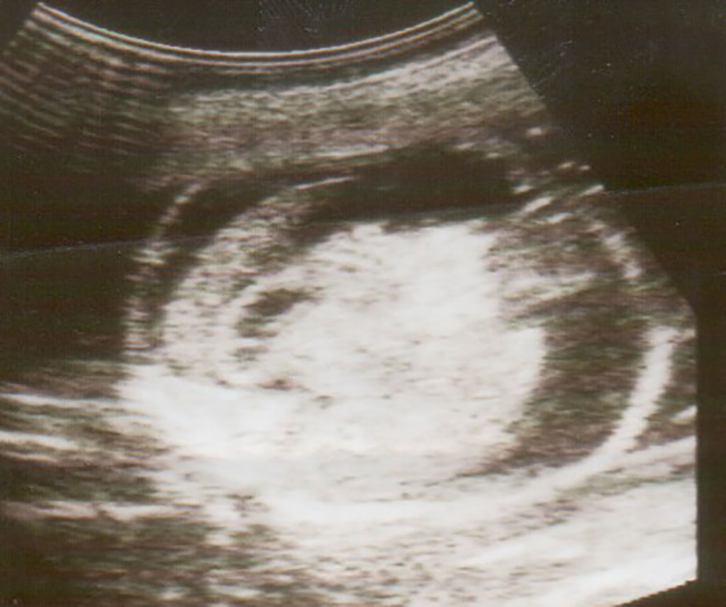 Image: Ultrasound scan of fetus showing hydrops fetalis (Photo courtesy of Wikimedia Commons)