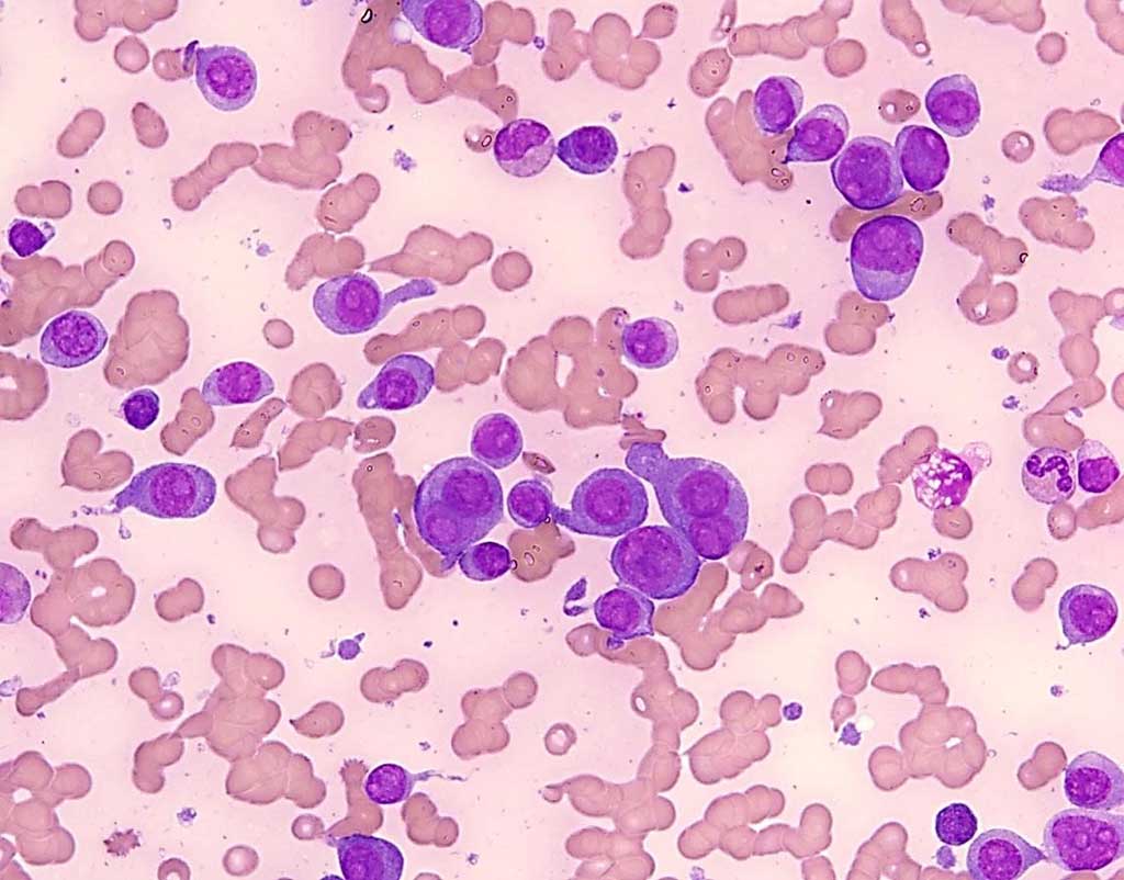 Image: Mutations in cell free DNA (cfDNA) or cells in the peripheral blood along with anemia or thrombocytopenia are the hallmark of myelodysplastic syndrome (MDS). The diagnosis of MDS is confirmed when mutations in hematopoietic cells are detected at relatively high levels (Photo courtesy of Genomic Testing Cooperative).