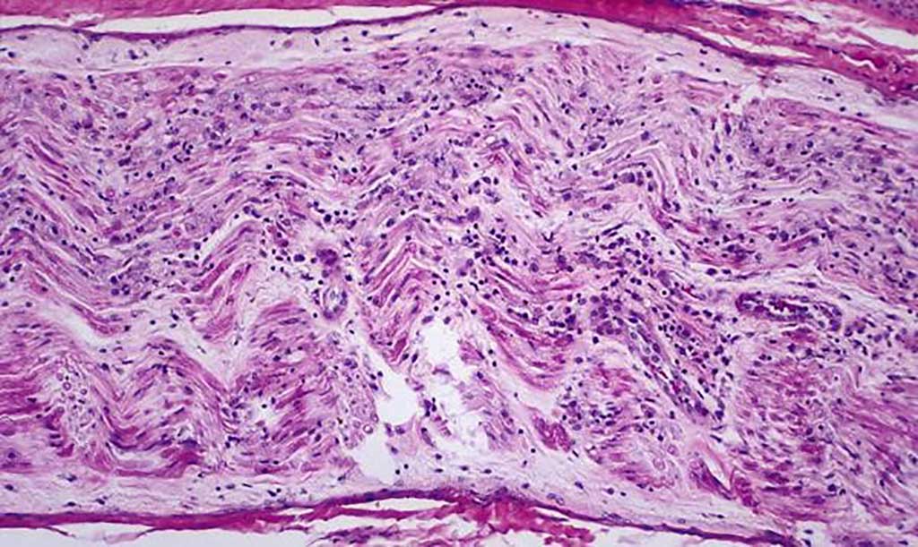 Image: Histopathology of Guillain-Barré syndrome: Inflammation in peripheral nerve (Photo courtesy of Dimitri P. Agamanolis, MD).