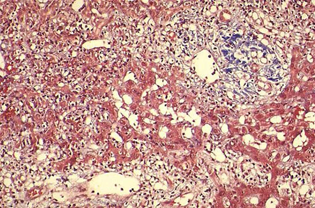 Image: Histopathology of a cirrhotic liver.  High-density lipoprotein cholesterol predicts survival in cirrhotic patients with acute gastrointestinal bleeding (Photo courtesy of Loyola University Chicago).