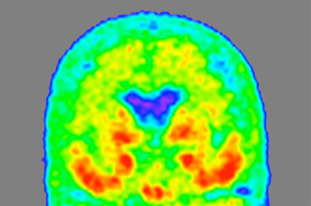 Image: A `heat map` of the brain of a person with mild Alzheimer's dementia shows where tau protein has accumulated, with areas of higher density in red and orange, and lower density in green and blue (Photo courtesy of Tammie Benzinger/Knight ADRC)