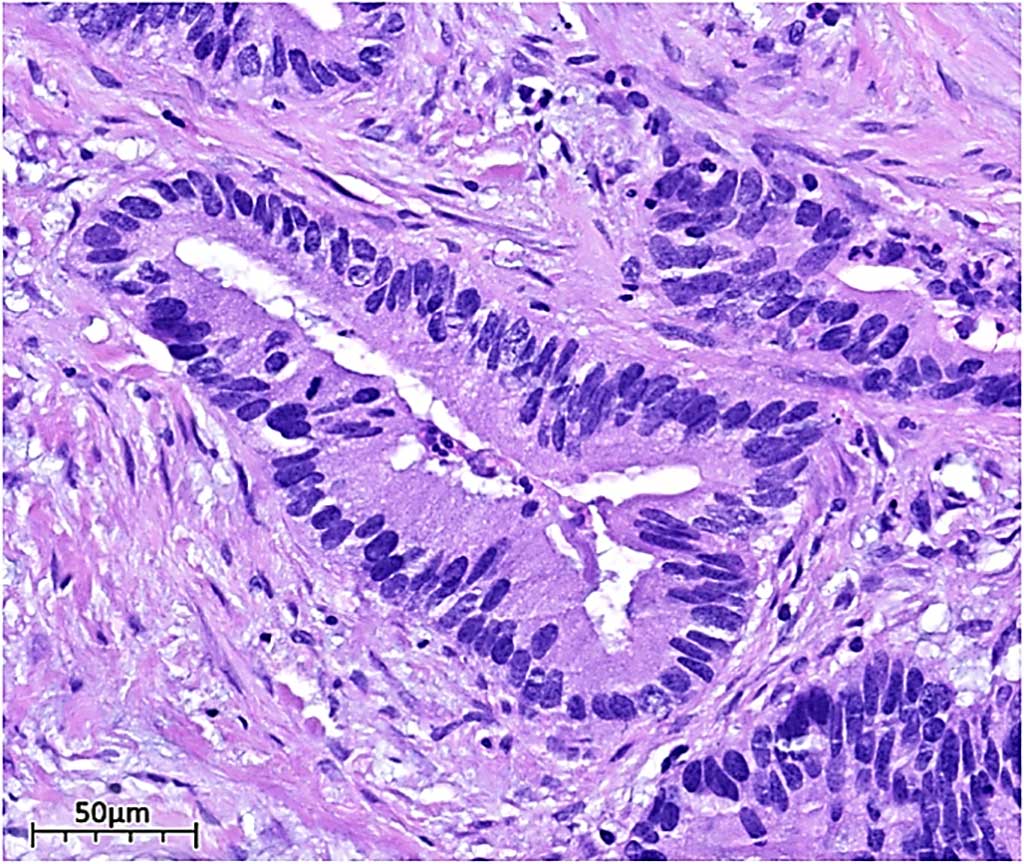 Image: Histopathology of dissected appendiceal tissue showing moderately differentiated neoplastic glands lined by cells with nuclear pleomorphism and hyperchromasia (Photo courtesy of Pacific Northwest University of Health Sciences).