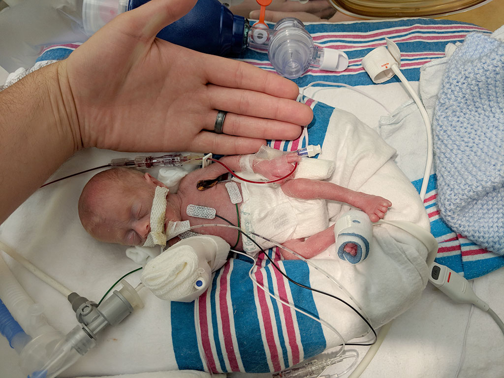 Image: An newborn infant at 26 weeks: for most preterm babies, a higher hemoglobin threshold for red-cell transfusion did not improve survival without neurodevelopmental impairment (Photo courtesy of Jaimie and John Florio)