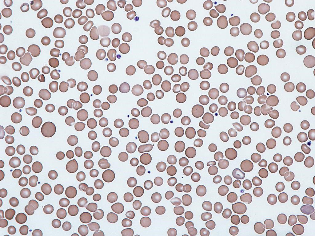 Image: Human erythrocytes showing variation in red cell distribution width (RDW), known as anisocytosis, higher levels may predict mortality in COVID-19 patients (Photo courtesy of Dr. Graham Beards)