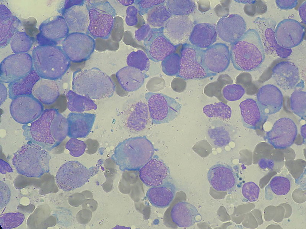 Image: Bone marrow aspirate showing acute myeloid leukemia (Photo courtesy of Wikipedia Commons)