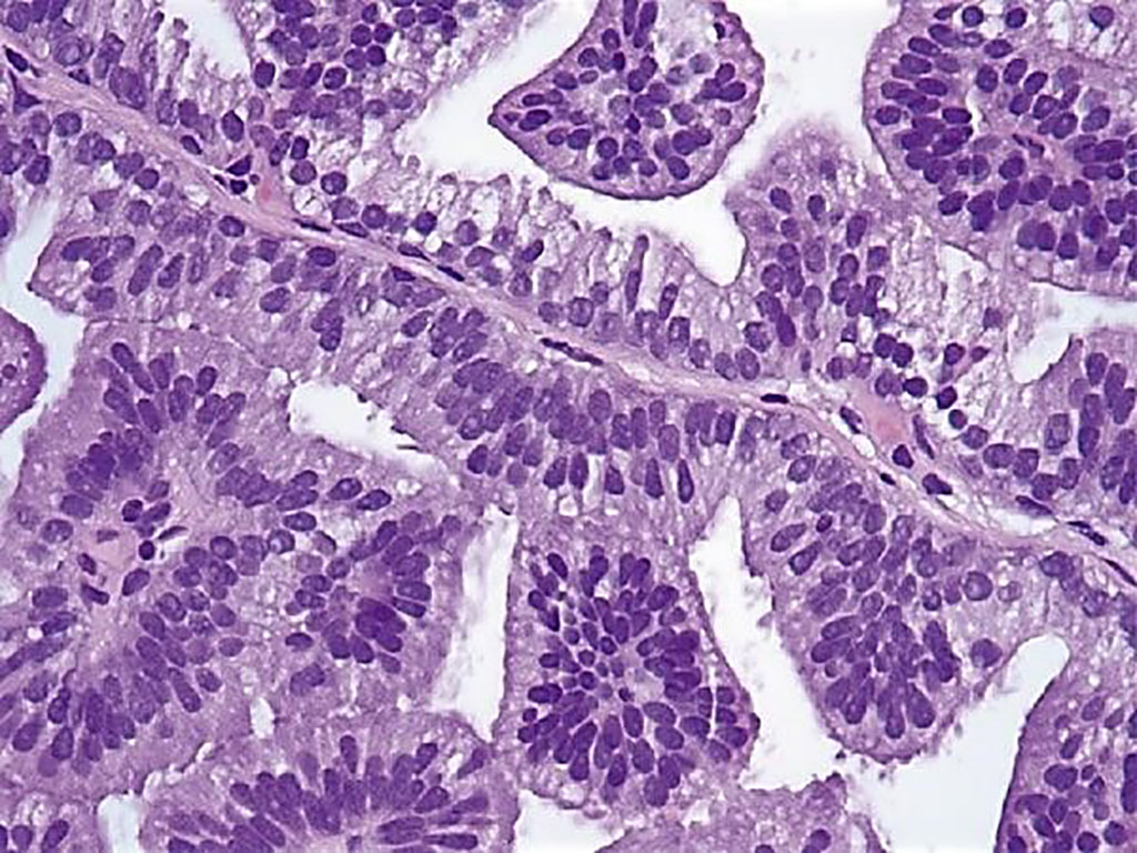 Image: High-power photomicrograph of ductal adenocarcinoma (Prostate cancer) illustrating tall columnar cells with pale to clear cytoplasm and large ovoid nuclei (Photo courtesy of David J. Grignon, MD).