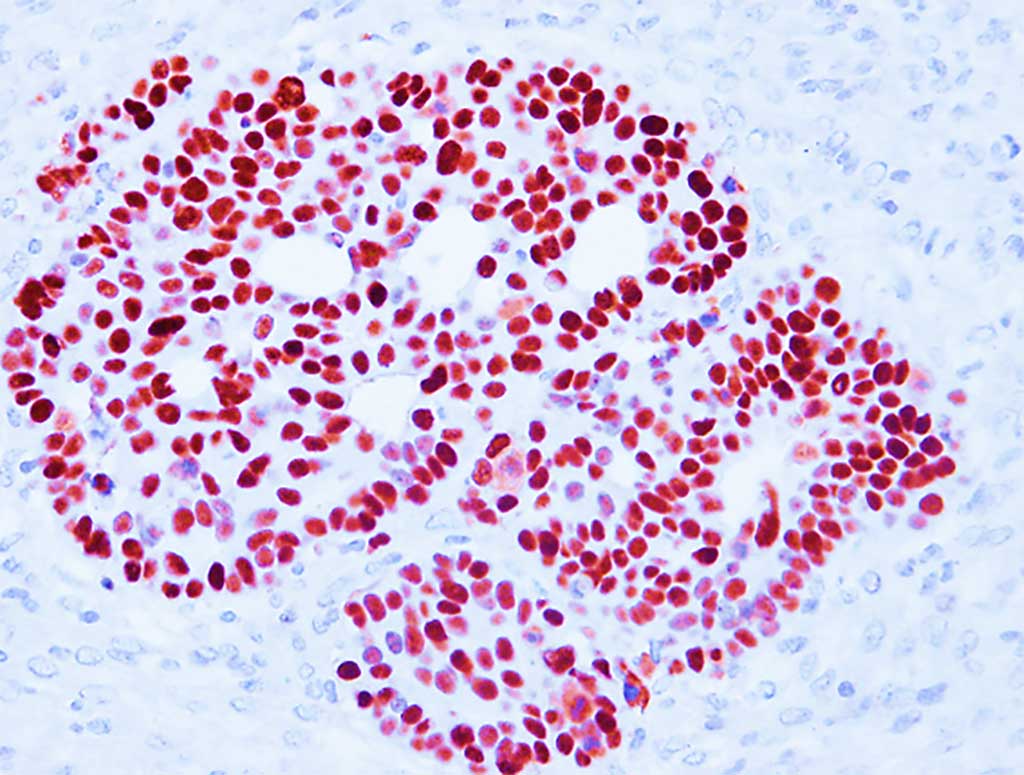 Image: Histopathologic image from a patient with Li Fraumeni syndrome showing accumulation of mutant TP53 in tumoral cells (Photo courtesy of Thierry Soussi, PhD).