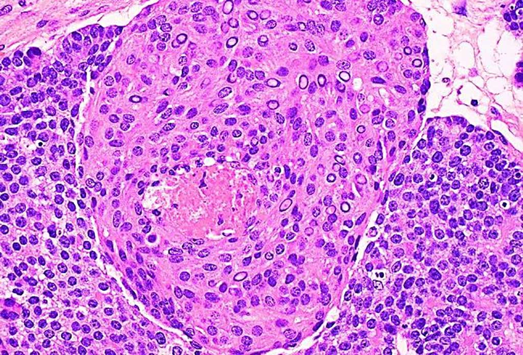 Image: Histopathology of pancreatoblastoma showing a large squamoid nest surrounded by sheet of bland monomorphic cells. Many of the squamous cell nuclei are optically clear due to accumulation of biotin (Photo courtesy of Dharam Ramnani, MD).