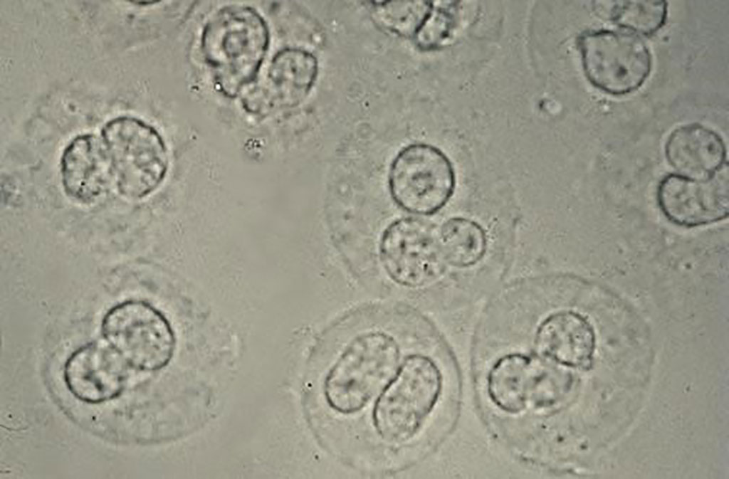 Image: White blood cells in the urine of a patient with bacteriuria pyuria, a urinary tract infection. The cells have lobed nuclei and refractile cytoplasmic granules (Photo courtesy of University of Utah Medical School).