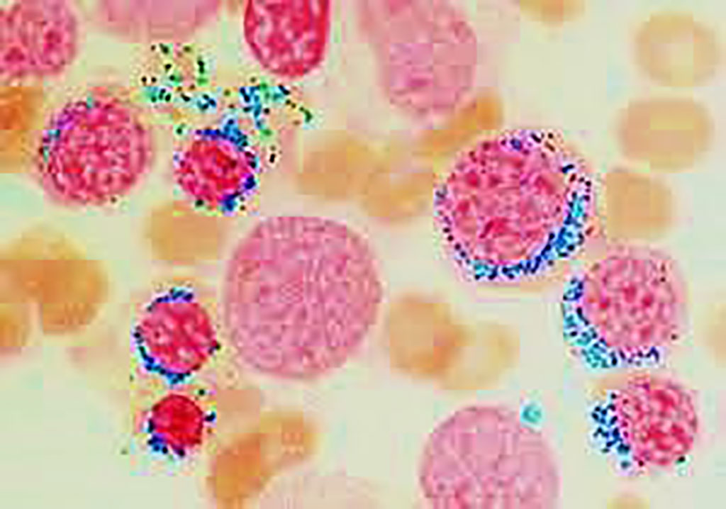 Image: Bone marrow smear from a patient with refractory anemia (MDS) with ring sideroblasts. Classic appearance of ring sideroblasts shows iron deposition in a `necklace` around the nucleus using Perls stain (Photo courtesy of University of Pavia)