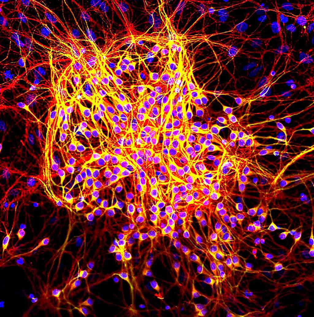 Image: Neurons were grown in tissue culture and stained with antibody to microtubule associated protein 2 (MAP2) protein in green and MAP tau in red. MAP2 is found only in dendrites and perikarya, while tau is found in these sites and in axons as well. DNA is shown in blue (Photo courtesy of EnCor Biotechnology Inc. via Wikimedia Commons)