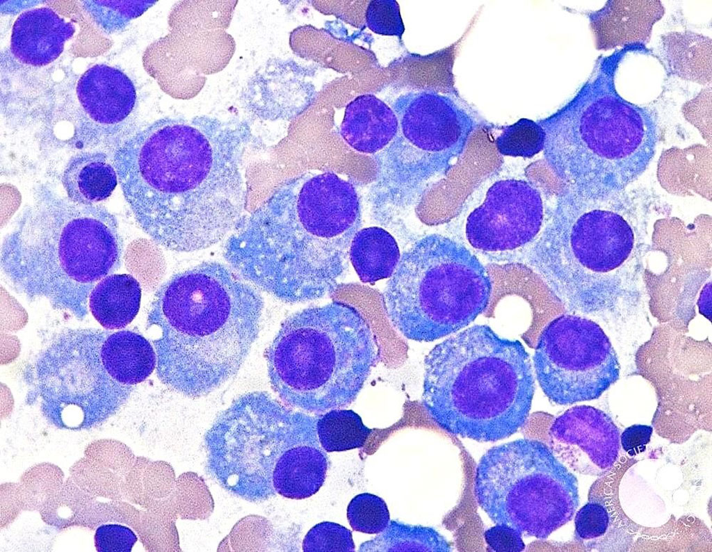 Image: Bone marrow aspirate showing mature plasma cells with eccentric nuclei and abundant basophilic cytoplasm indicative of multiple myeloma (Photo courtesy of Dr. David Israel Garrido, MD et.al.)