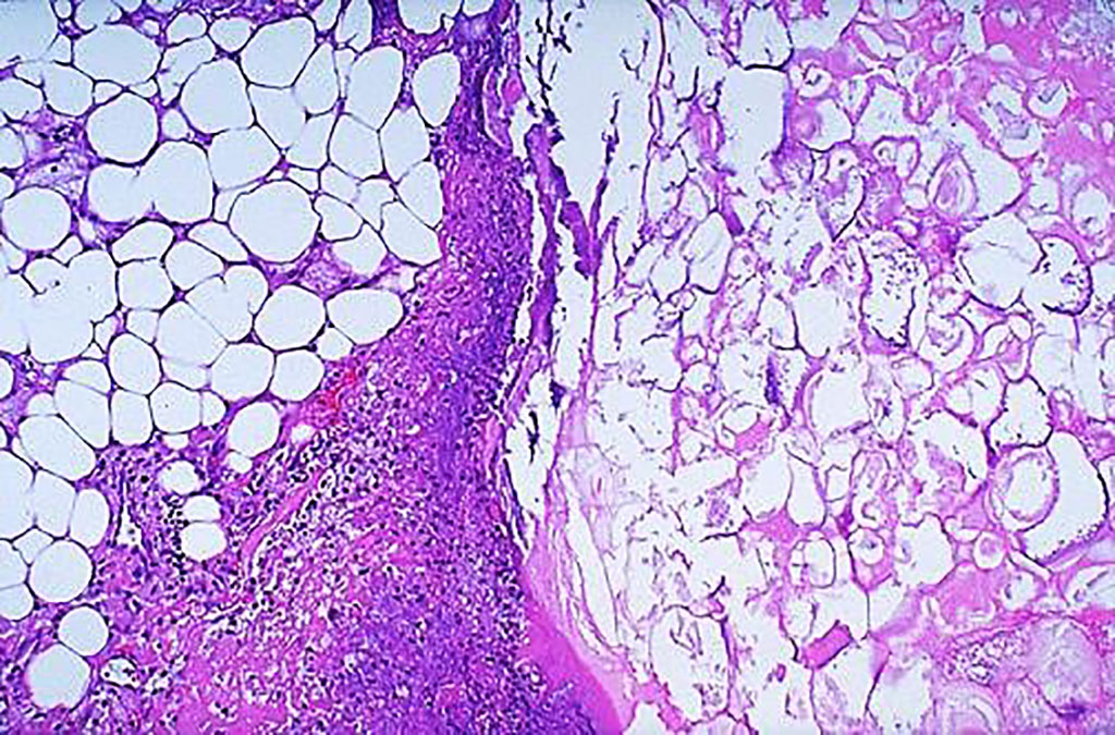 Image: Histology of acute pancreatitis. Microscopically, the fat necrosis consists of steatocytes (adipocytes) that have lost their nuclei and whose cytoplasm has a granular pink appearance as seen on the right. Some hemorrhage is seen at the left in this case of acute pancreatitis (Photo courtesy of Texas A&M University)