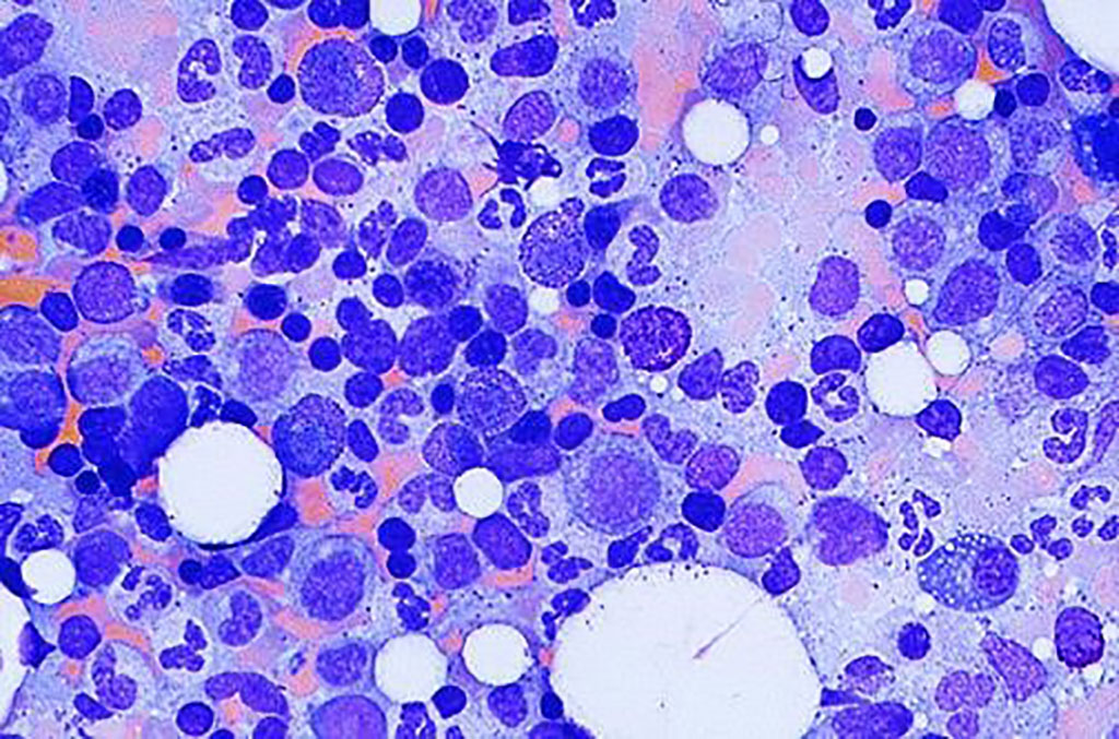Image: A normal bone marrow biopsy: Note the presence of an eosinophilic myelocyte, a basophilic myelocyte, and a plasma cell. There is an association between a common, benign genotype and unnecessary bone marrow biopsies among African-American patients (Photo courtesy of University of Utah School of Medicine)