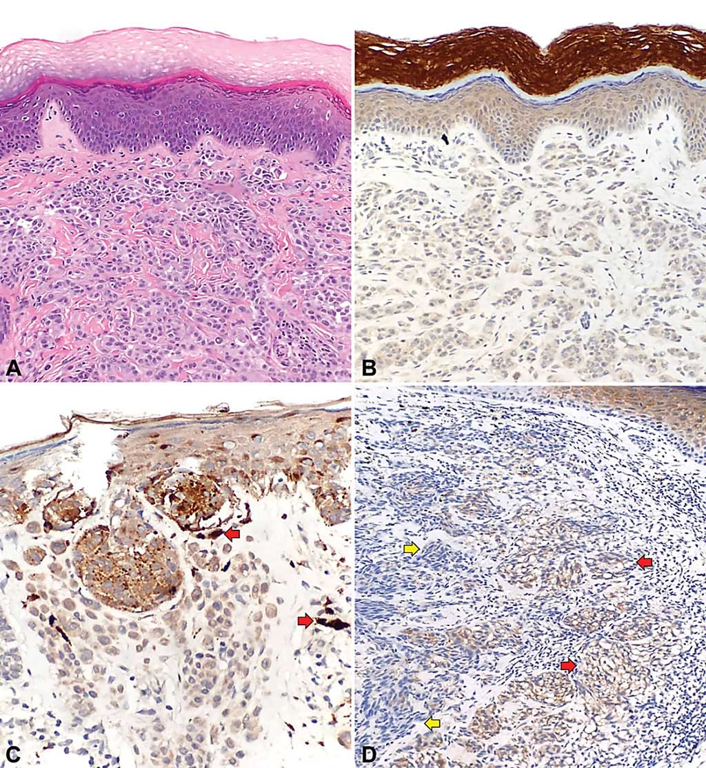 Image: Telomerase reverse transcriptase (TERT) expression in non-lentiginous acral melanoma (NLAM) and non-acral cutaneous melanoma (NACM): (A) exhibiting 1+ TERT staining intensity and (B) The intensity of TERT expression and proportion of TERT-positive cells could also vary in cutaneous melanomas (Photo courtesy of MD Anderson Cancer Center)