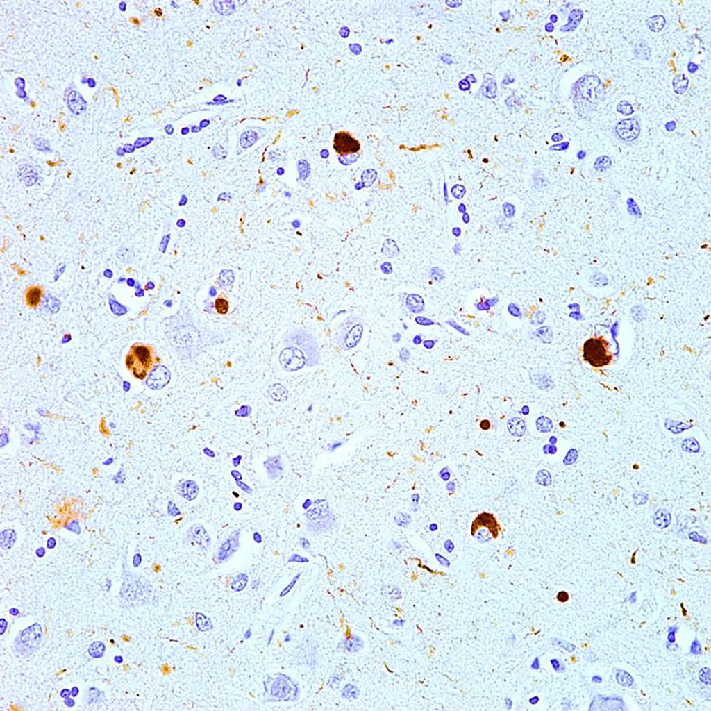 Photomicrograph shows brown-immunostained alpha-synuclein in Lewy bodies (large clumps) and Lewy neurites (thread-like structures) in the neocortical tissue of a person who died with Lewy body disease (Photo courtesy of Movalley)