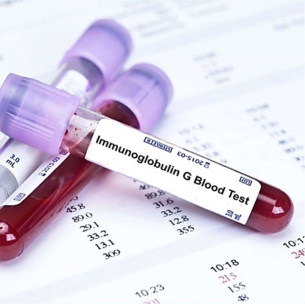 Image: Blood sample tube for Immunoglobulin G or IgG subclass test (Photo courtesy of Blood Tests London)