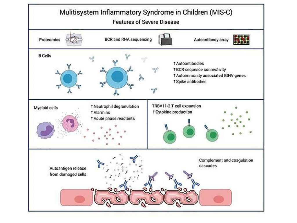 Image: The autoimmune signature of hyperinflammatory multisystem inflammatory syndrome in children (Photo courtesy of Cedars-Sinai Medical Center)