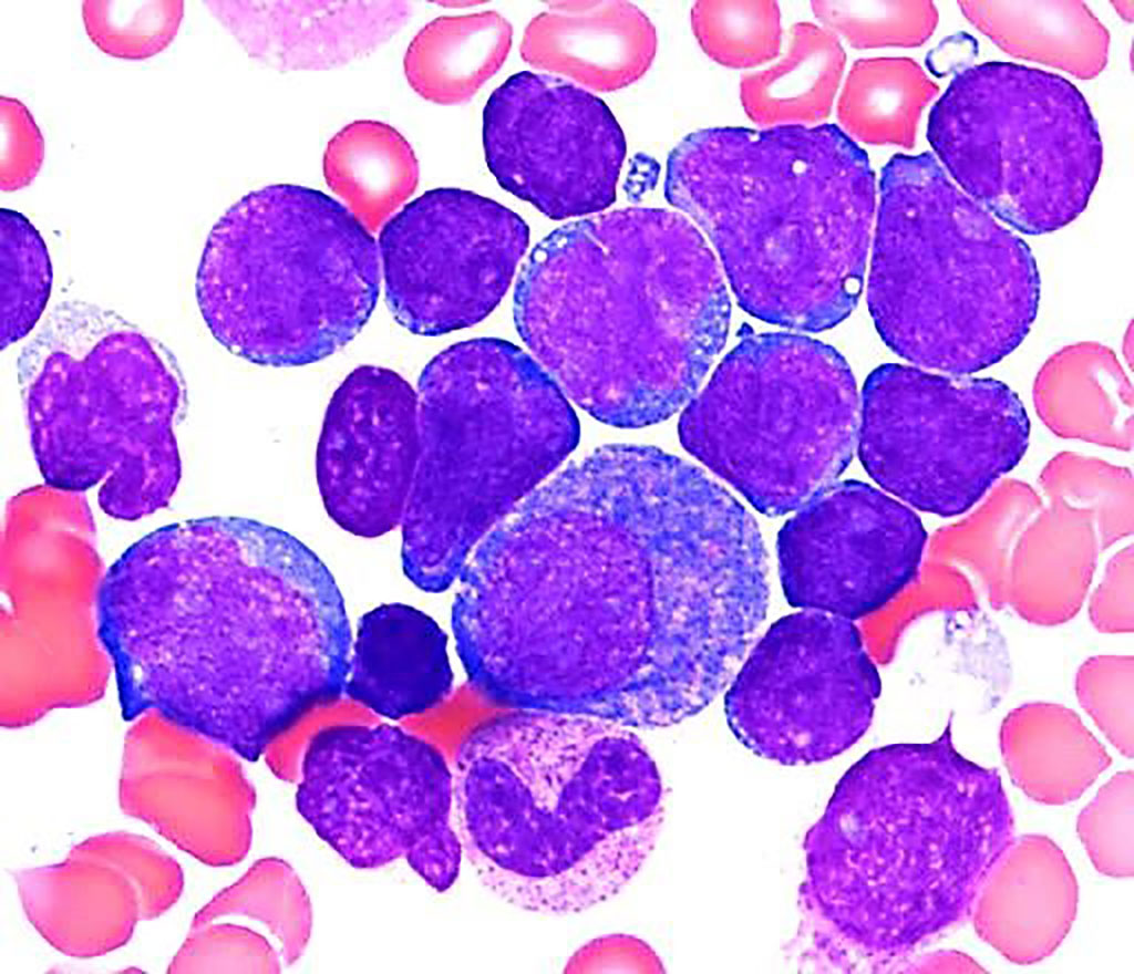 Image: Acute lymphoblastic leukemia: bone marrow aspirate smear reveals increased blasts which are small to medium in size with high nuclear-to-cytoplasmic ratios, round to irregular nuclei, smooth chromatin, and scant basophilic agranular cytoplasm. Some background maturing myeloid cells are also present in this case (Photo courtesy of Karen M. Chisholm, MD, PhD)