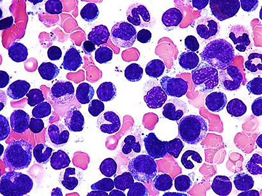 Image: Bone marrow aspirate from a patient with peripheral T-cell lymphoma (Photo courtesy of Peter Maslak, MD)
