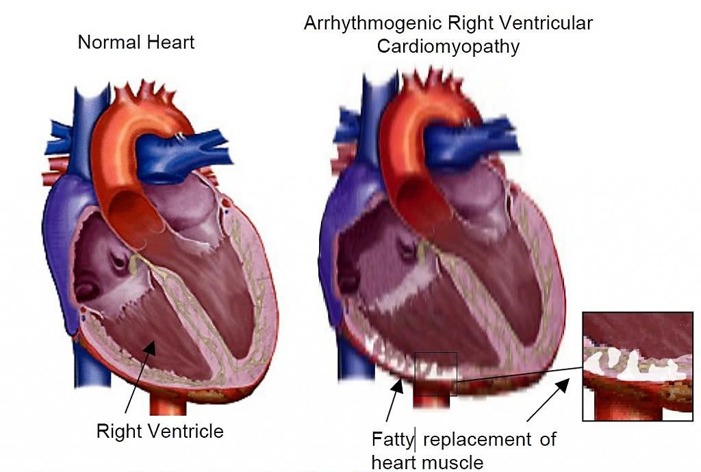 Image: Arrhythmogenic Right Ventricular Cardiomyopathy (ARVC) is caused by a build-up of fatty deposits and fibrous tissue on the right ventricle, the chamber of the heart that pumps blood into the lungs (Photo courtesy of National Heart Foundation of Australia)