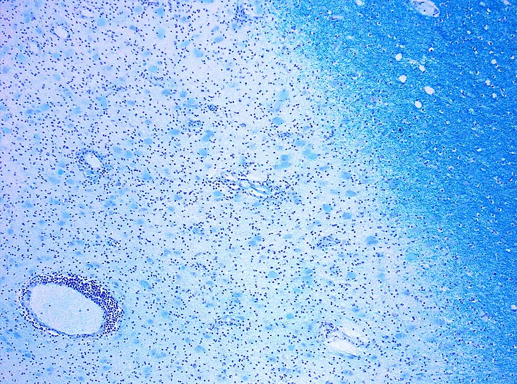 Image: Histopathology of Multiple Sclerosis showing demyelination; decoloration in the area of the lesion can be observed using Klüver-Barrera myelin staining (Photo courtesy of Marvin 101)