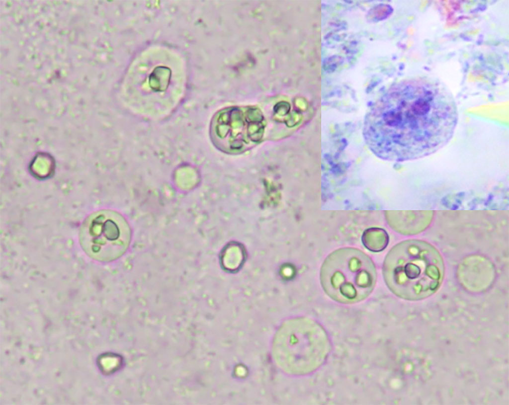 Image: Dientamoeba fragilis trophozoites in culture. Note that D. fragilis trophozoites ingested rice starch while Blastocystis spp., did not. Confirmation with microscopic examination of trichrome-stained smears are required (Inset) (Photo courtesy of Manisa Celal Bayar University School of Medicine)