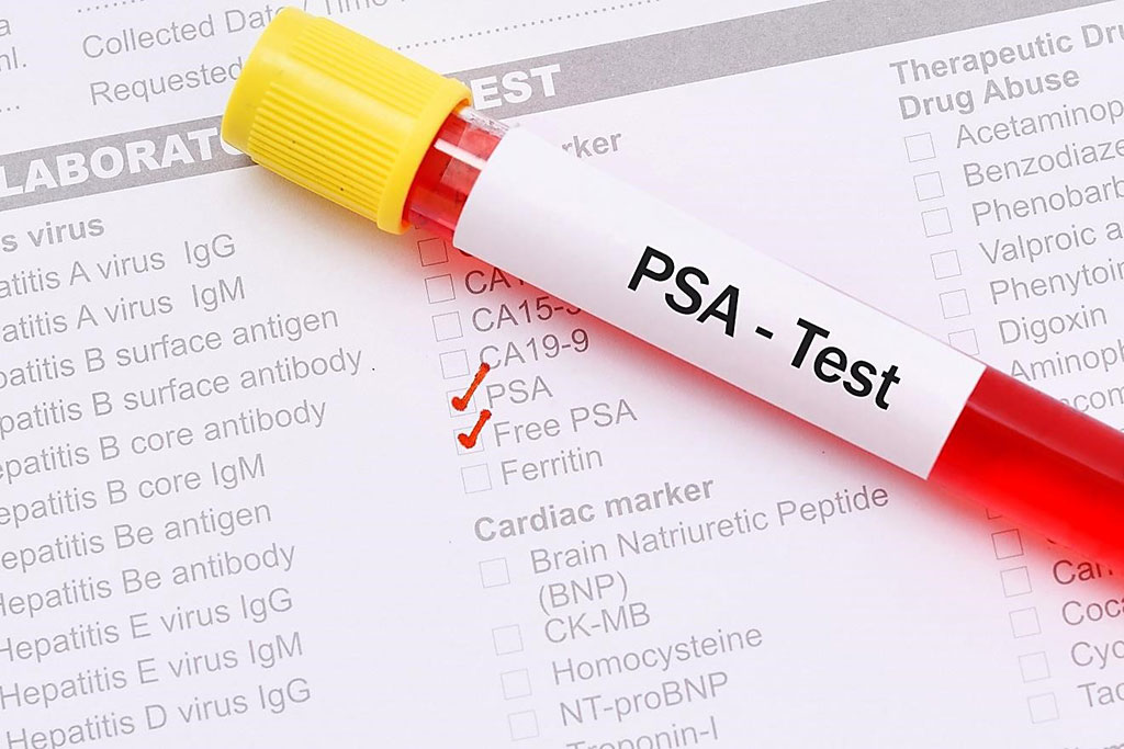 Despre PSA seric – antigenul prostatic specific