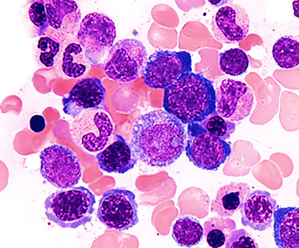 Image: Bone marrow smear from a person with myelodysplastic syndrome showing aberrant morphology and maturation (dysmyelopoiesis), resulting in ineffective blood cell production (Photo courtesy of Melbourne Blood Specialists)
