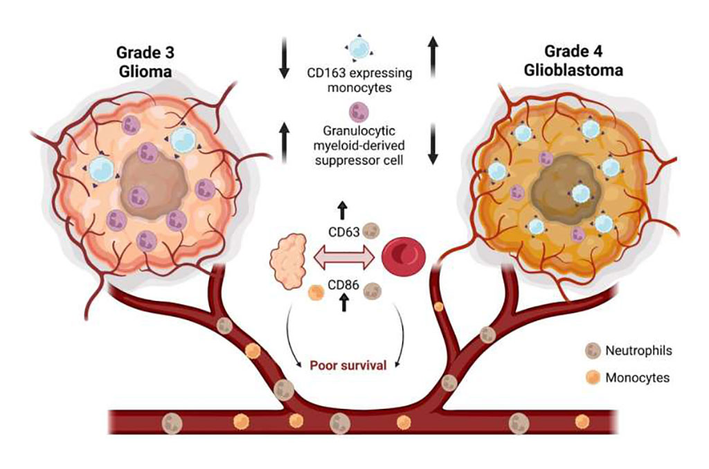 Image: A comparison of monocyte and neutrophil phenotype in grade III and grade IV gliomas (Photo courtesy of Jayashree V. Raghavan)